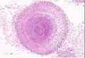 Aspergillosis.　無数の菌糸が集合しsunburst様の像を示す。