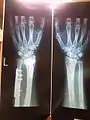 左腕にプレートが埋め込まれているのがはっきりとわかる。右腕は比較用。