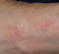 足の疥癬