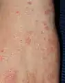 手の疥癬