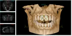 歯科用CBCT
