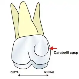 カラベリー結節