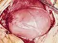 小児の心横紋筋腫