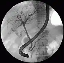 ERCP image showing the pancreatic duct and en:biliary tree.