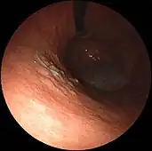 胃体部にみられた早期胃癌内視鏡像(高分化型腺癌)
