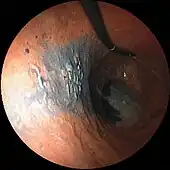 左と同じ症例(高分化型腺癌)のインジゴカルミン染色内視鏡像
