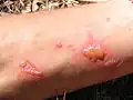 ヘンルーダへの皮膚への接触部位に太陽光が照射された場合の光毒性（英語版）反応