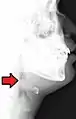 thumb sign を呈した側面X線写真。Thumb sign, Vallecula sign が認められる。