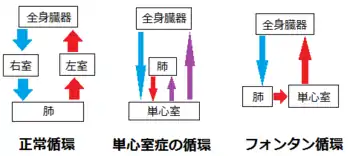 正常循環・単心室症の循環・フォンタン循環の図解例。赤は動脈血(酸素化血)、青は静脈血(脱酸素化血)、紫はチアノーゼを表す。