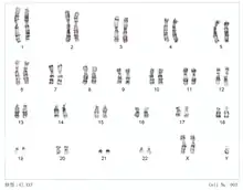 クラインフェルター症候群(性染色体XXY)