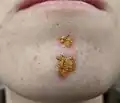 Impetigo