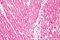 心筋梗塞を起こした人の核溶解、収縮帯壊死(画像の左)、(核のある)虚血心筋細胞(画像の右)の顕微鏡画像。