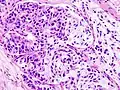 大唾液腺に発生した粘表皮癌の病理組織像。HE染色