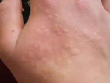 セイヨウイラクサによる皮膚炎