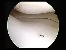 大腿骨(上)と脛骨(下)の間の正常な内側半月 (膝関節鏡検査)