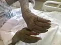 極度に角質増殖した手腕