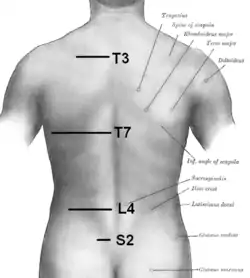 脊椎を表皮で示した図。T3は肩甲棘の中間部分にあり、T7は肩甲骨の下角にある。L4は腸骨稜の最も上の点にある。S2は上後腸骨棘の高さにある。さらにC7は首の下部に突出部として簡単に局在化される。