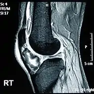 骨軟骨腫 / 大腿骨下端 （MRI）