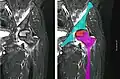 左大腿骨頭の無血管壊死の核磁気共鳴。エイズの45歳の男性。