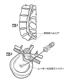 経皮的レーザー椎間板減圧術の図解