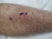 免疫性血小板減少性紫斑病で下肢に紫斑が生じている
