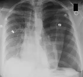 Chest X-ray showing a pneumothorax on the right (left in the image), where the absence of lung markings indicates that there is free air inside the chest