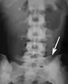 L5椎骨の仙椎化。画像の右下に見られる。