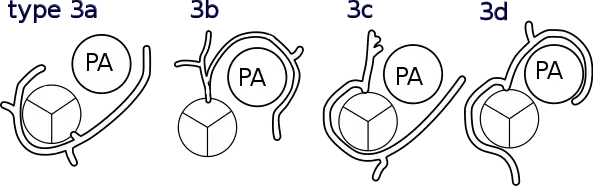 Shaher classification of TGA