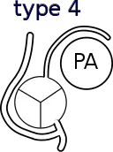 Shaher classification of TGA
