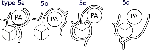 Shaher classification of TGA
