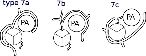 Shaher classification of TGA