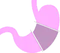 胃体部切除