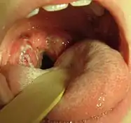 咽頭の奥の扁桃腺が腫脹し白い滲出物に覆われている。培養試験でレンサ球菌咽頭炎陽性の8歳の小児。典型的な扁桃からの滲出がみられる。