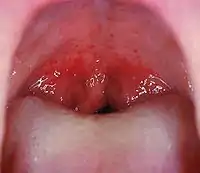 口を大きく開けた状態で咽頭を撮影。軟口蓋に点状出血(小さな赤い斑点)が認められる。これは頻度は低いが特異度の高いレンサ球菌咽頭炎の所見である。