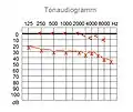 オージオグラム、伝音性難聴の例