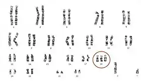 エドワーズ症候群男児(18トリソミー)