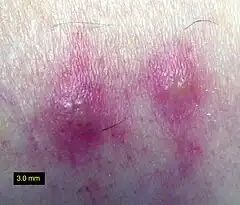 ツツガムシに噛まれた症状