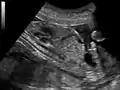 Ultrasound of fetus showing urachus duct from bladder to the umbilicus.