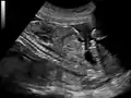 Ultrasound of fetus showing urachus duct from bladder to the umbilicus.