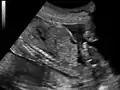Ultrasound of fetus showing urachus duct from bladder to the umbilicus.