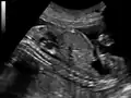 Ultrasound of fetus showing urachus duct from bladder to the umbilicus.