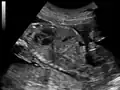 Ultrasound of fetus showing urachus duct from bladder to the umbilicus.