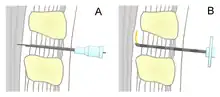 Schematische Darstellung von Spinalanästhesie (A) und Periduralanästhesie (B)