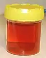 血尿