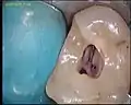 穿孔し抜髄