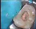 4つ全ての根管を処置