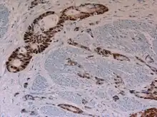尿膜管癌 - CDX2 immunohistochemistry